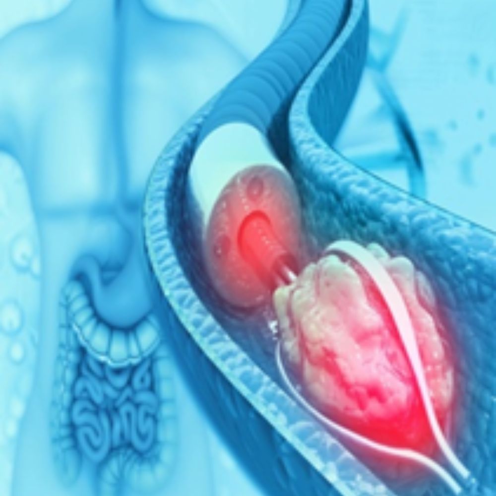 Laser stone surgery image 1