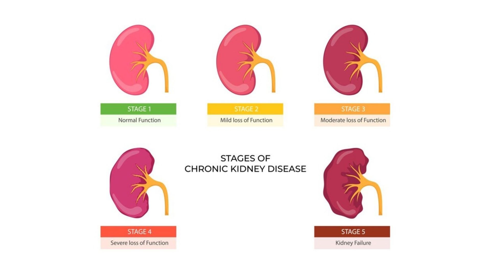 Stages of Chronic Kidney Disease