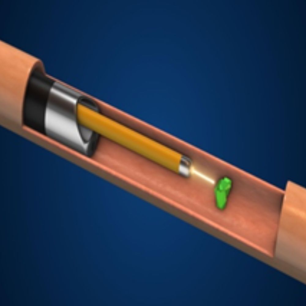 Laser stone surgery image 2