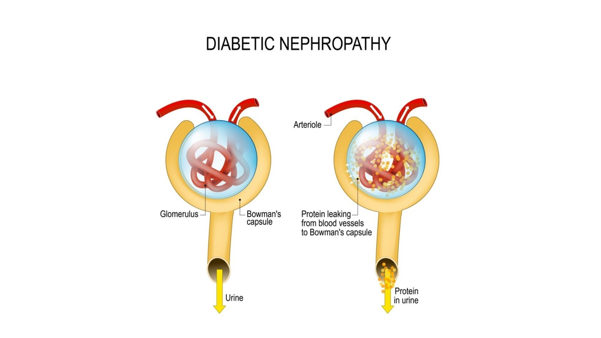 Diabetic Nephropathy — protein leaking from blood vessels