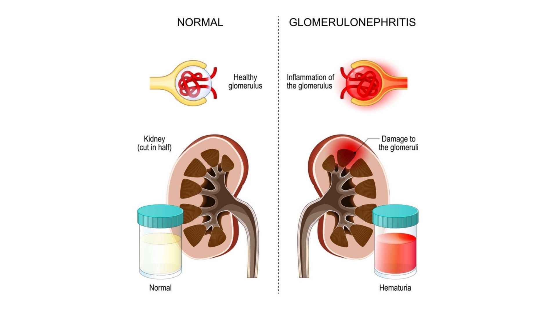 Glomerulonephritis — inflammation of the glomerulus