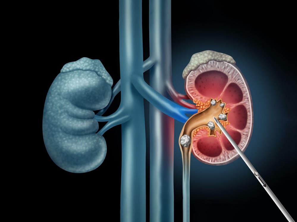 Dr. D K Chughh – Kidney Transplant Surgeon Delhi NCR