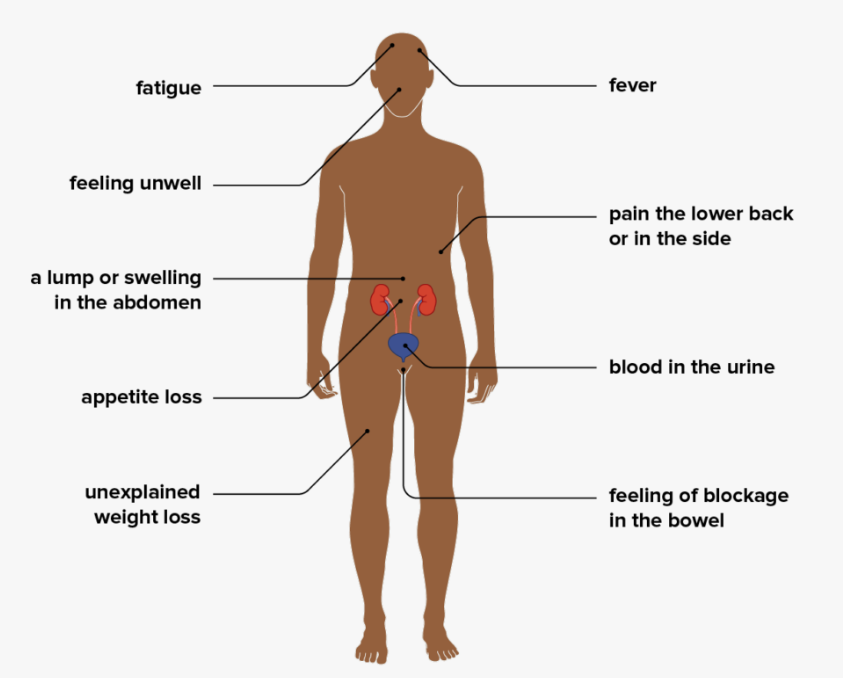 Kidney Tumor Symptoms