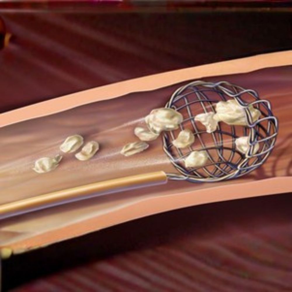 URSL procedure image 3