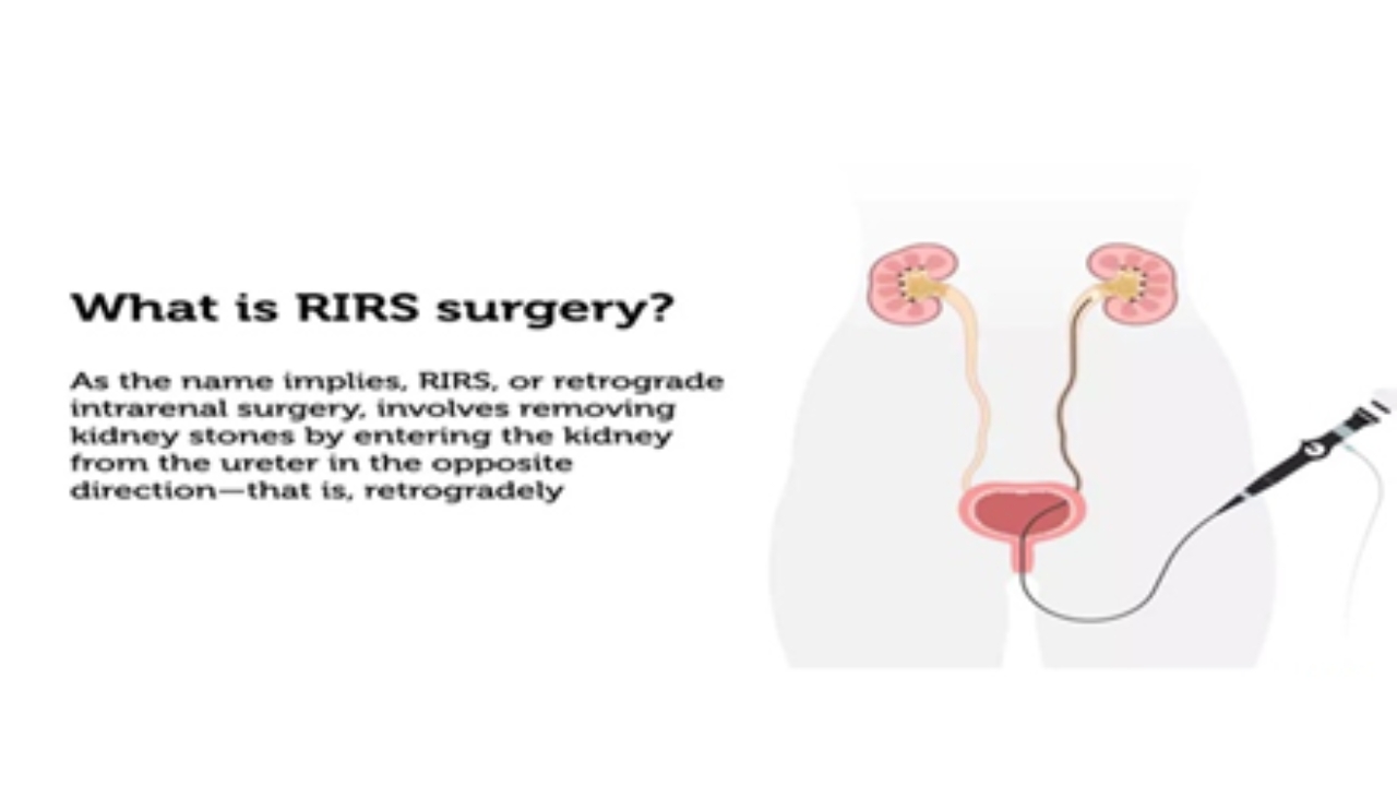 RIRS procedure image 1