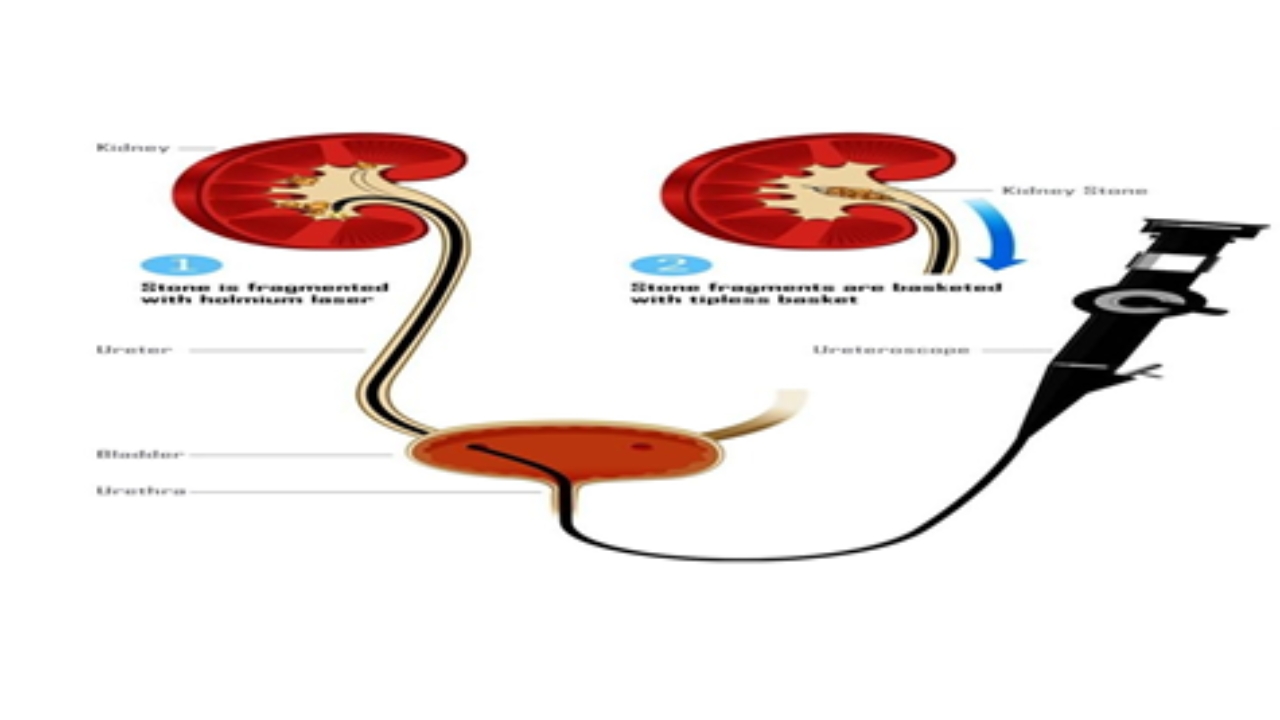 RIRS procedure image 2