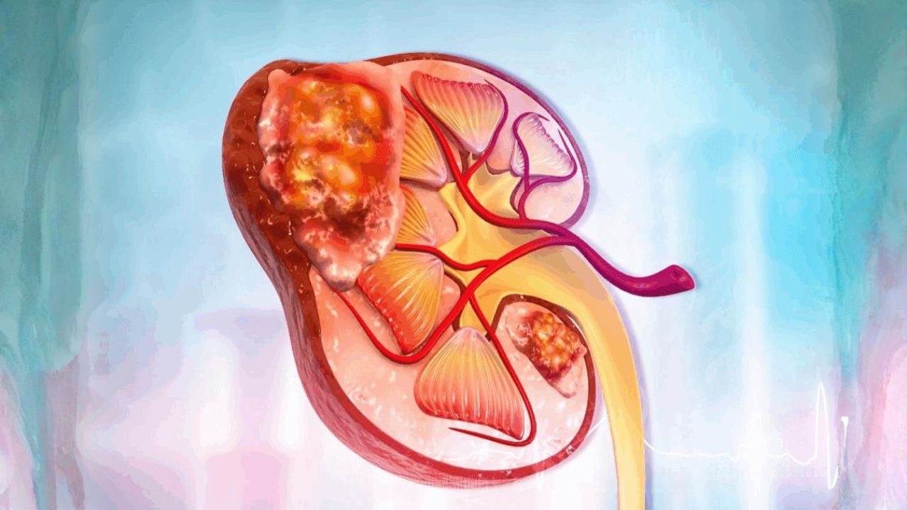 What is a Kidney Tumor