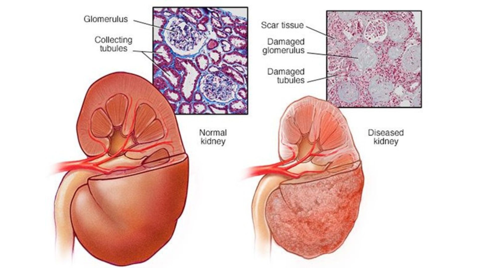 Normal kidney vs diseased kidney