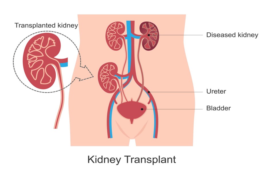 Failed Previous Transplant