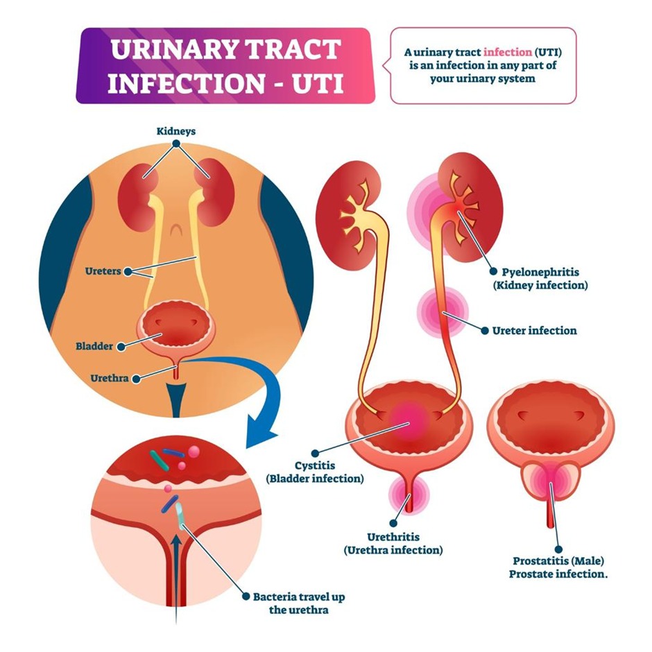 Urinary Tract Infection