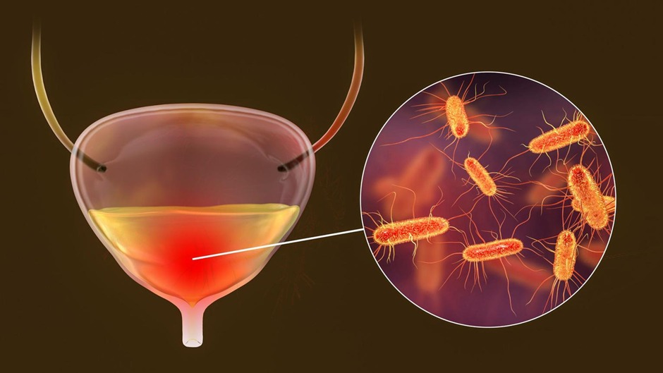 UTI Can Lead to Kidney Infection