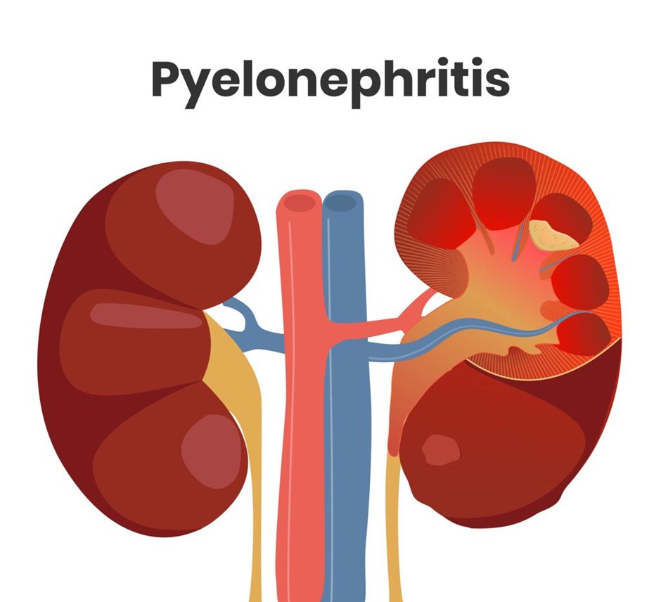 Pyelonephritis Kidney Infection