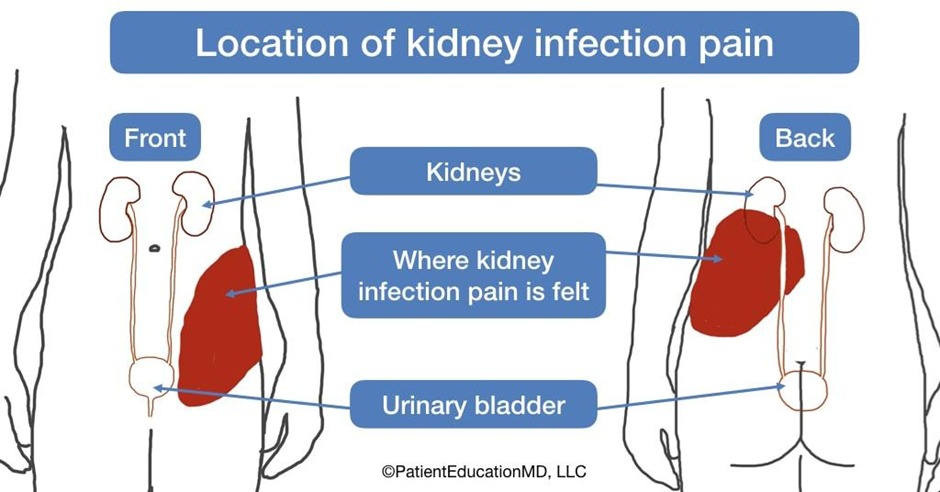 Location of Kidney Infection Pain