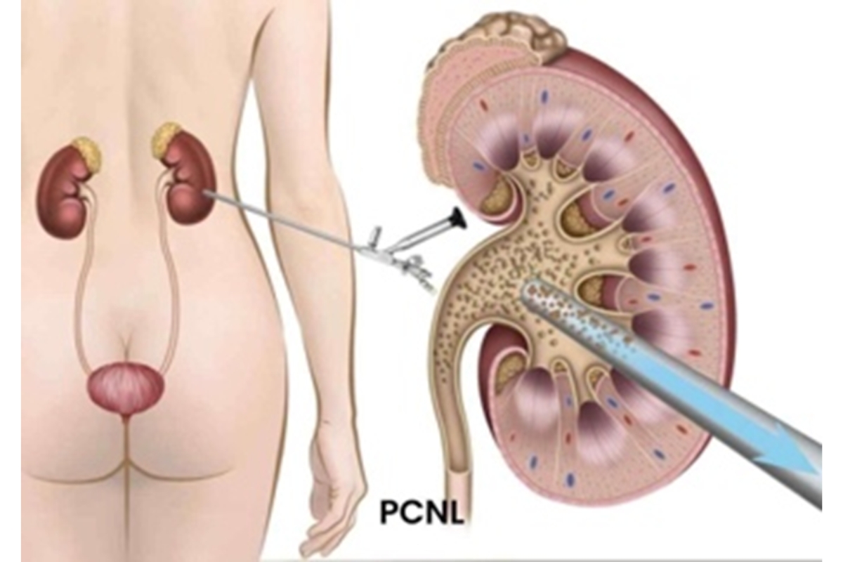 PCNL Procedure Step Image 4