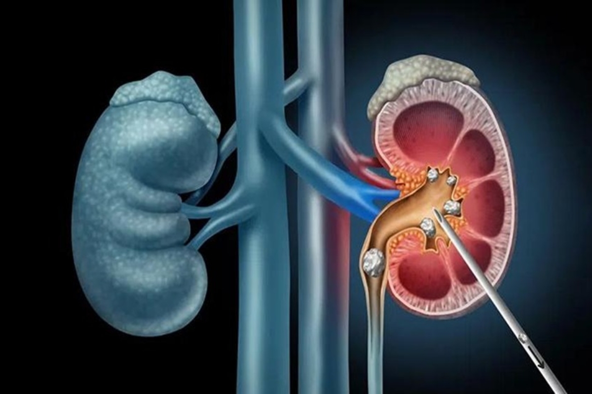 PCNL Procedure Step Image 3