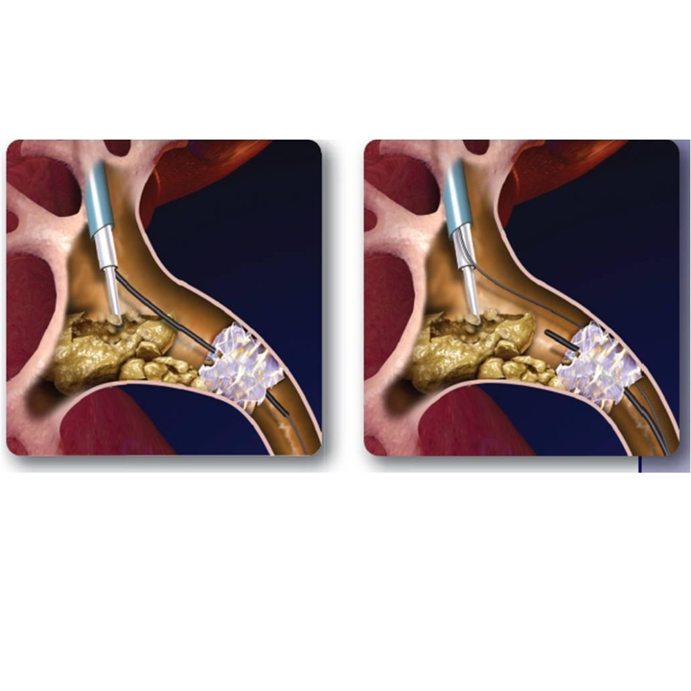 Laser stone surgery image 3