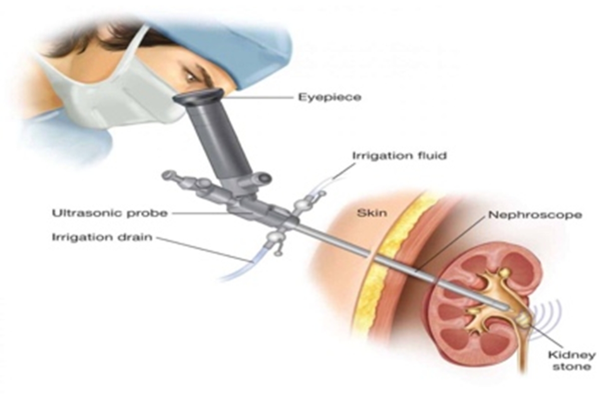 PCNL Procedure Step Image 1