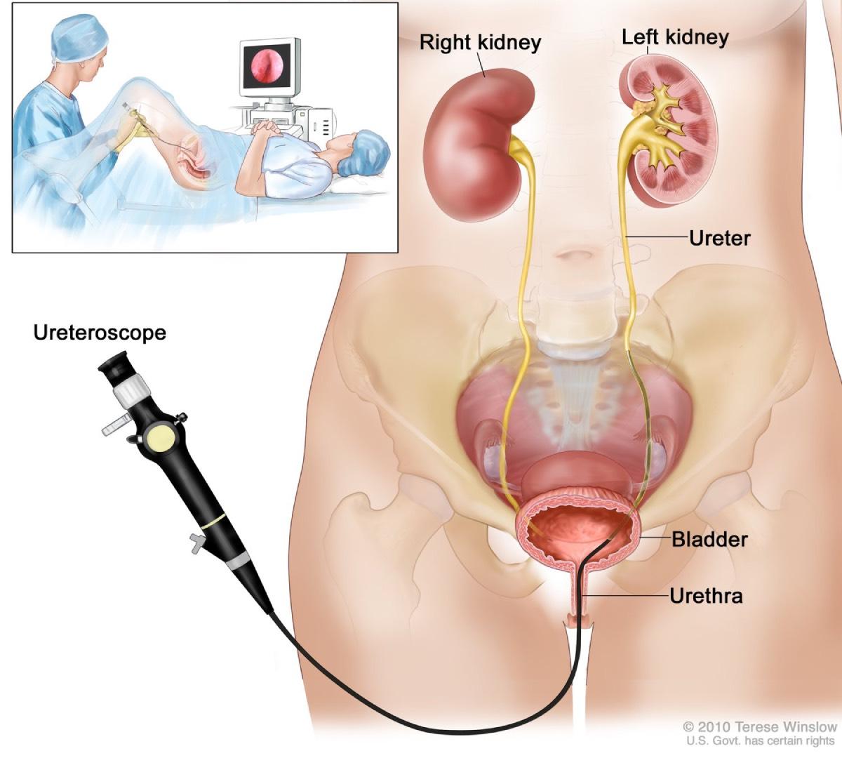 RIRS procedure image 4