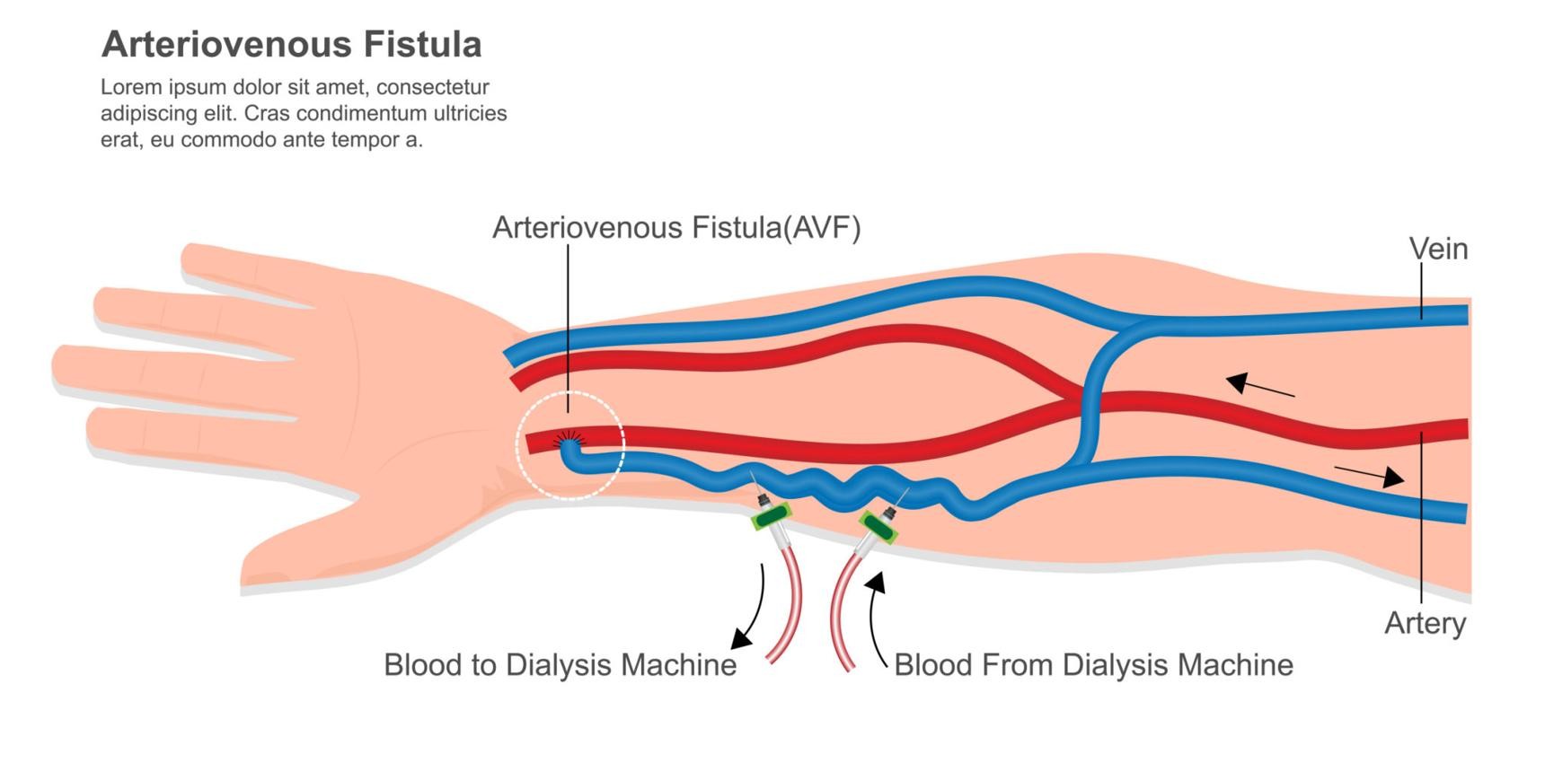 Successful AV Fistula