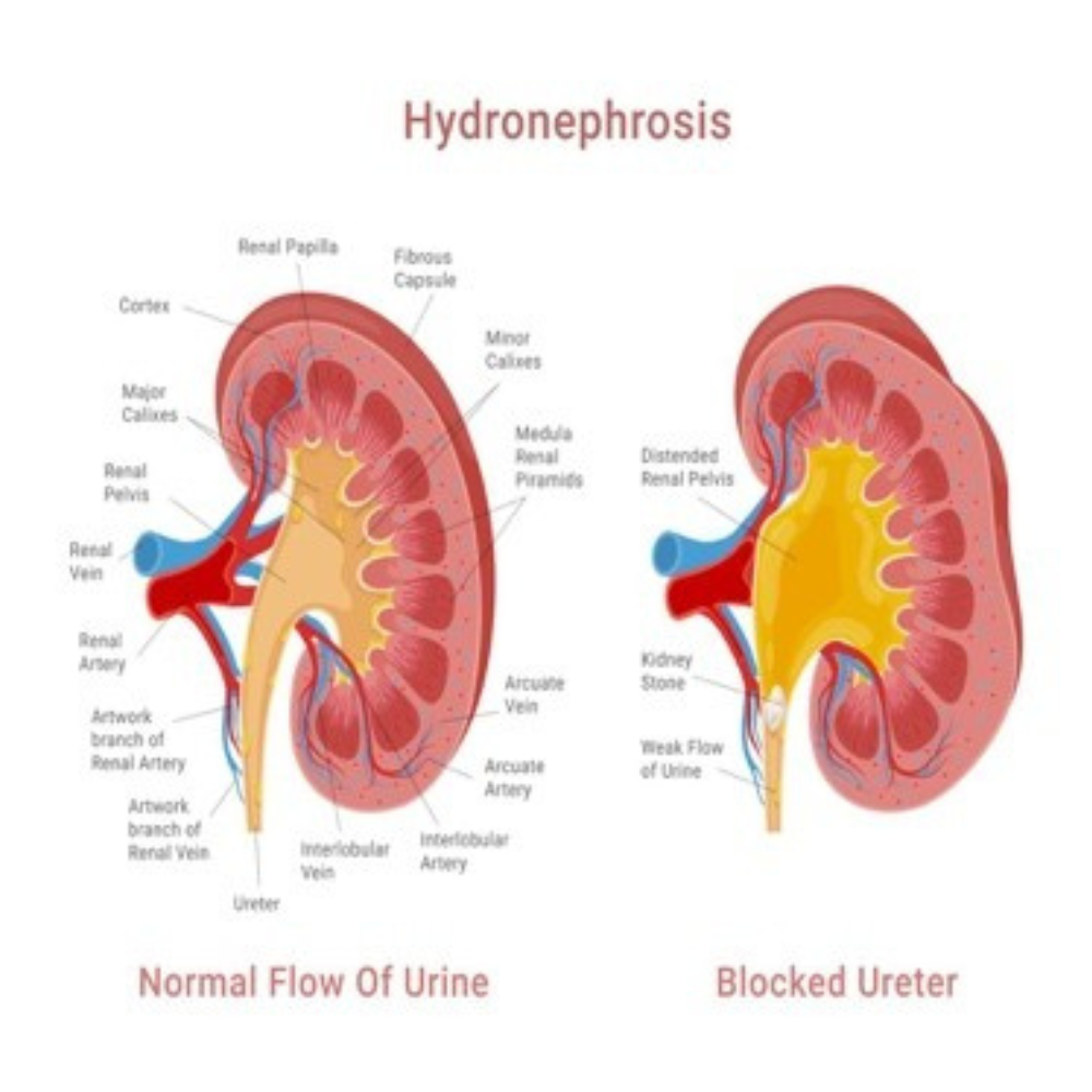 Hydronephrosis — Normal Flow vs Blocked Ureter