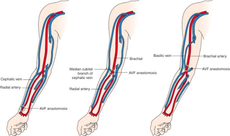 AV Fistula Surgery Procedure