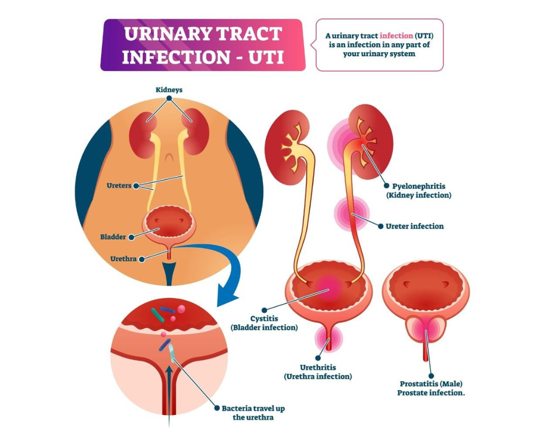 Urinary Tract Infection Overview Diagram