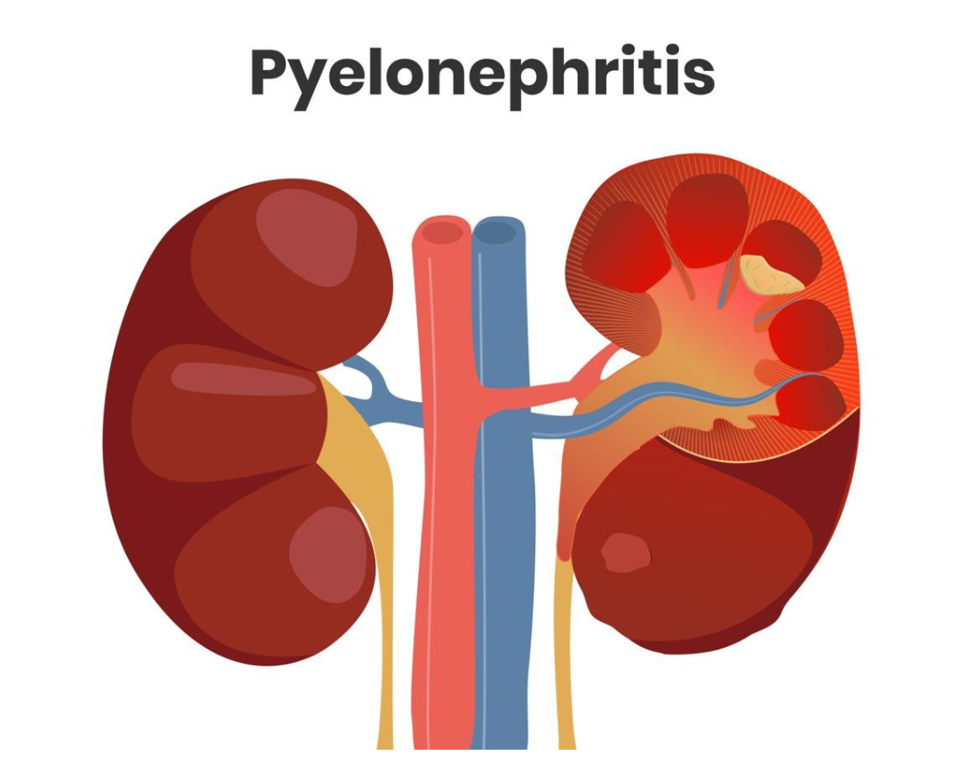 Kidney Infection Pyelonephritis Diagram