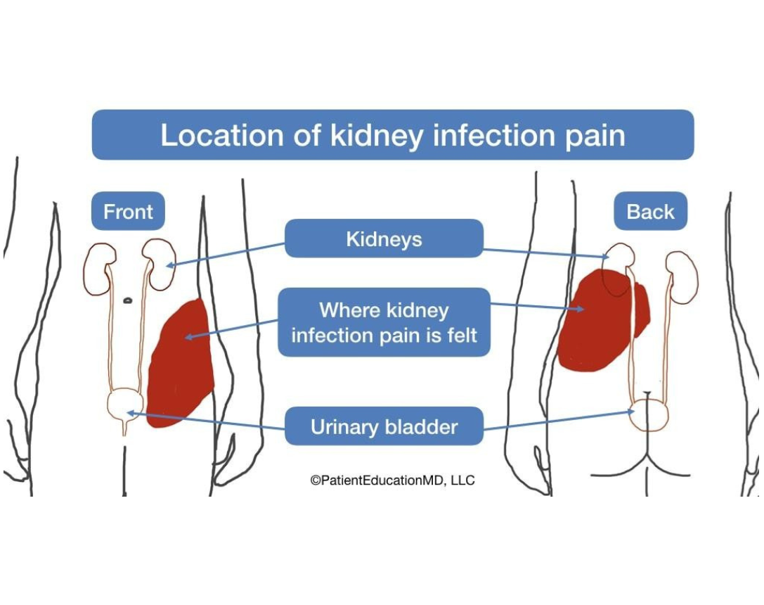 Kidney Infection Pain Location
